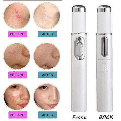Laser Treatment Blue Light Therapy Acne Skin Care - Image 2